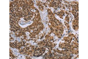 Immunohistochemistry of Human colon cancer using CCL21 Polyclonal Antibody at dilution of 1:40 (CCL21 抗体)