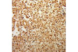 Immunohistochemistry of paraffin-embedded Osteosarcoma using FGF2 antibody. (FGF2 抗体  (AA 143-288))
