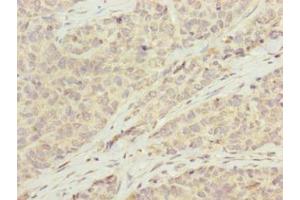 Immunohistochemistry of paraffin-embedded human ovarian cancer using ABIN7145848 at dilution of 1:100 (KCTD19 抗体  (AA 490-751))