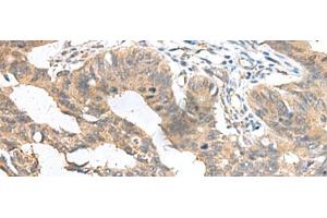 Immunohistochemistry of paraffin-embedded Human colorectal cancer tissue using MIA Polyclonal Antibody at dilution of 1:100(x200) (MIA 抗体)