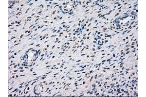 Immunohistochemical staining of paraffin-embedded Adenocarcinoma of breast tissue using anti-STK3 mouse monoclonal antibody. (STK3 抗体)