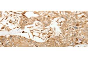 Immunohistochemistry of paraffin-embedded Human esophagus cancer tissue using VMA21 Polyclonal Antibody at dilution of 1:150(x200) (VMA21 抗体)