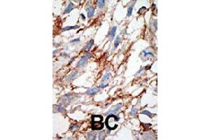 Formalin-fixed and paraffin-embedded human cancer tissue reacted with ISG15 polyclonal antibody  , which was peroxidase-conjugated to the secondary antibody, followed by DAB staining. (ISG15 抗体  (N-Term))