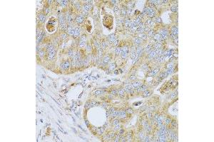 Immunohistochemistry of paraffin-embedded human colon carcinoma using PSG1 antibody at dilution of 1:100 (40x lens). (PSG1 抗体)