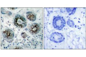 Immunohistochemical analysis of paraffin-embedded human breast carcinoma tissue using GAP43(Ab-41) Antibody(left) or the same antibody preincubated with blocking peptide(right). (GAP43 抗体)
