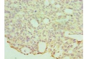 Immunohistochemistry of paraffin-embedded human endommetrial cancer using ABIN7155970 at dilution of 1:100 (HYAL1 抗体  (AA 136-435))