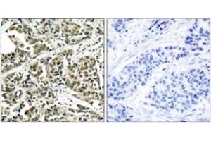 Immunohistochemistry analysis of paraffin-embedded human breast carcinoma tissue, using BRCA1 (Ab-1524) Antibody. (BRCA1 抗体  (AA 1491-1540))