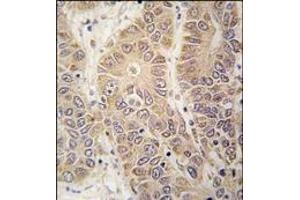 Formalin-fixed and paraffin-embedded human hepatocarcinoma tissue reacted with HARS antibody (N-term), which was peroxidase-conjugated to the secondary antibody, followed by DAB staining. (HARS1/Jo-1 抗体  (N-Term))
