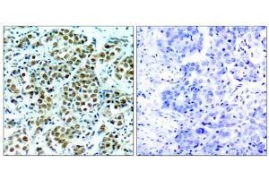 Immunohistochemical analysis of paraffin-embedded human breast carcinoma tissue, using p90RSK (phospho-Thr348) antibody (E011105). (RPS6KA3 抗体  (pThr348))
