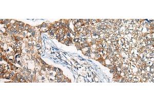 Immunohistochemistry of paraffin-embedded Human lung cancer tissue using BBS12 Polyclonal Antibody at dilution of 1:50(x200) (BBS12 抗体)