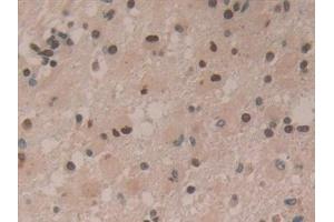 Detection of HDGF in Human Glioma Tissue using Polyclonal Antibody to Hepatoma Derived Growth Factor (HDGF) (HDGF 抗体  (AA 10-240))