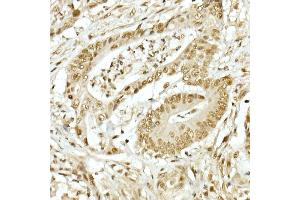 Immunohistochemistry of paraffin-embedded human colon carcinoma using TOPBP1 Rabbit pAb (ABIN6129493, ABIN6149398, ABIN6149401 and ABIN6221465) at dilution of 1:50 (40x lens). (TOPBP1 抗体  (AA 1253-1522))