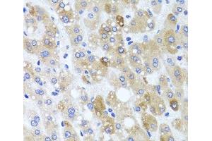 Immunohistochemistry of paraffin-embedded Human liver damage using ATP7A Polyclonal Antibody at dilution of 1:100 (40x lens). (ATP7A 抗体)