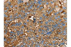 The image on the left is immunohistochemistry of paraffin-embedded Human breast cancer tissue using ABIN7130083(LGALS3BP Antibody) at dilution 1/25, on the right is treated with fusion protein. (LGALS3BP 抗体)