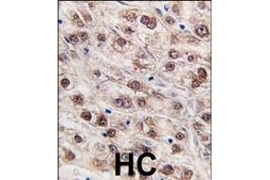 Formalin-fixed and paraffin-embedded human hepatocarcinoma tissue reacted with JMJD4 (C-term) (ABIN387875 and ABIN2844081) , which was peroxidase-conjugated to the secondary antibody, followed by DAB staining. (JMJD4 抗体  (C-Term))