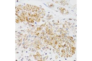 Immunohistochemistry of paraffin-embedded human prostate cancer using MYO5A antibody (ABIN6003562) at dilution of 1/100 (40x lens). (MYO5A 抗体)