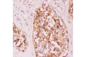 Anti-Crk p38 Picoband antibody,  IHC(P): Human Lung Cancer Tissue