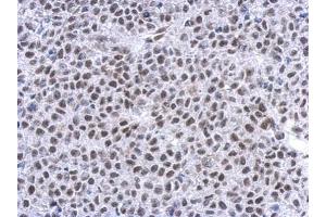 IHC-P Image Immunohistochemical analysis of paraffin-embedded Hela xenograft, using Glucocorticoid receptor, antibody at 1:500 dilution. (Glucocorticoid Receptor 抗体  (N-Term))