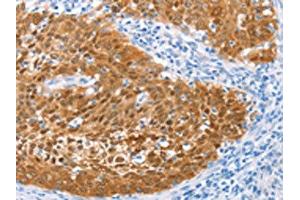 The image on the left is immunohistochemistry of paraffin-embedded Human cervical cancer tissue using ABIN7129916(IRF6 Antibody) at dilution 1/50, on the right is treated with fusion protein. (IRF6 抗体)