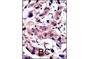 Formalin-fixed and paraffin-embedded human cancer tissue reacted with the primary antibody, which was peroxidase-conjugated to the secondary antibody, followed by AEC staining.