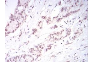 Immunohistochemical analysis of paraffin-embedded colon cancer tissues using DNMT3B mouse mAb with DAB staining. (DNMT3B 抗体  (AA 1-150))