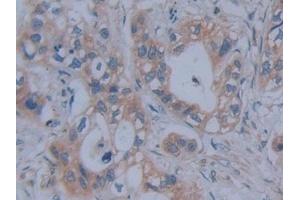 Detection of FBN1 in Human Pancreatic cancer Tissue using Polyclonal Antibody to Fibrillin 1 (FBN1) (Fibrillin 1 抗体  (AA 246-389))