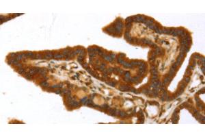 Immunohistochemistry of paraffin-embedded Human thyroid cancer using TP53I11 Polyclonal Antibody at dilution of 1:40 (TP53I11 抗体)