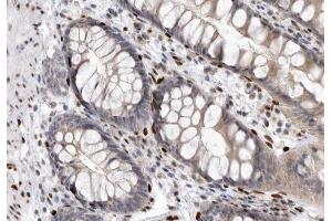 ABIN6267322 at 1/200 staining human colon carcinoma tissue sections by IHC-P. (EIF4E 抗体  (pSer209))