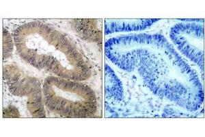 Immunohistochemical analysis of paraffin- embedded human colon carcinoma tissue, using IKKα (phospho-Thr23) antibody (E011129). (IKK alpha 抗体  (pThr23))