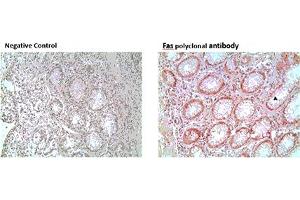 Immunohistochemistry analysis of formalin-fixed, paraffin-embedded human colon tumor tissue stained with Fas polyclonal antibody,  at 10 μg/mL. (FAS 抗体)