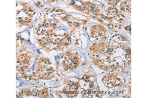 Immunohistochemistry of Human thyroid cancer using CTSL Polyclonal Antibody at dilution of 1:40 (Cathepsin L 抗体)