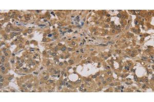 Immunohistochemistry of paraffin-embedded Human thyroid cancer tissue using DEGS1 Polyclonal Antibody at dilution 1:30 (DEGS1 抗体)