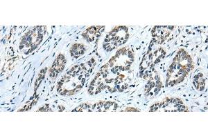 Immunohistochemistry of paraffin-embedded Human esophagus cancer tissue using GMFB Polyclonal Antibody at dilution of 1:25(x200) (GMFB 抗体)