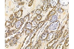 ABIN7096023 and ABIN7100085 at 1/100 staining human ovarian cancer by IHC-P. (MAPK1IP1L 抗体)