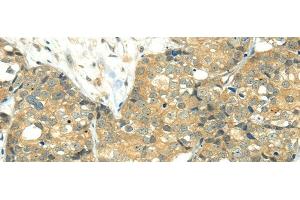 Immunohistochemistry of paraffin-embedded Human breast cancer using TRIM10 Polyclonal Antibody at dilution of 1/35 (TRIM10 抗体)