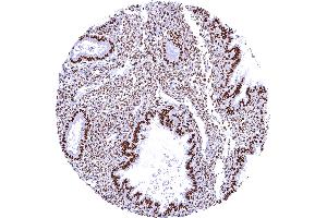 Intense nuclear SMARCA4 staining of all cell types of the endometrium