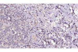 ABIN6273158 at 1/100 staining Human lymph cancer tissue by IHC-P. (SACM1L 抗体  (Internal Region))