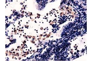 Immunohistochemical staining of paraffin-embedded Carcinoma of Human lung tissue using anti-MICAL1 mouse monoclonal antibody. (MICAL1 抗体)
