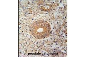 S35E2 Antibody (N-term) (ABIN654754 and ABIN2844438) immunohistochemistry analysis in formalin fixed and paraffin embedded human prostate carcinoma followed by peroxidase conjugation of the secondary antibody and DAB staining. (SLC35E2 抗体  (N-Term))