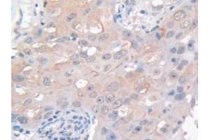 IHC-P analysis of Human Breast Cancer Tissue, with DAB staining. (GAMT 抗体  (AA 64-236))