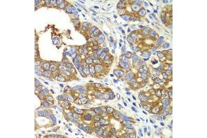 Immunohistochemistry of paraffin-embedded human gastric cancer using QARS antibody.