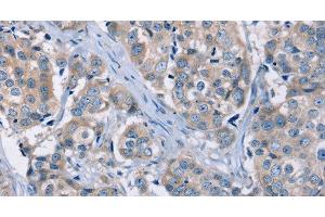 Immunohistochemistry of paraffin-embedded Human breast cancer using KCNQ5 Polyclonal Antibody at dilution of 1:30 (KCNQ5 抗体)