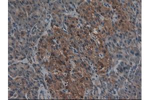 Immunohistochemical staining of paraffin-embedded Carcinoma of kidney using anti-CPA1 (ABIN2452540) mouse monoclonal antibody. (CPA1 抗体  (AA 1-419))