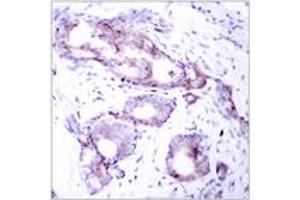 Immunohistochemistry analysis of paraffin-embedded human breast carcinoma, using Myc (Phospho-Ser373) Antibody. (c-MYC 抗体  (pSer373))