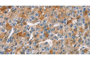 Immunohistochemistry of paraffin-embedded Human liver cancer using BCL10 Polyclonal Antibody at dilution of 1:40 (BCL10 抗体)