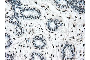 Immunohistochemical staining of paraffin-embedded breast tissue using anti-BRAF mouse monoclonal antibody. (BRAF 抗体)