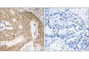 Immunohistochemistry analysis of paraffin-embedded human colon carcinoma tissue, using DAP Antibody. (DAP 抗体  (AA 11-60))
