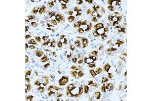 Immunohistochemical analysis of PRG2 staining in human gastric cancer formalin fixed paraffin embedded tissue section. (PRG2 抗体)