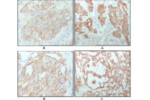 Immunohistochemical analysis of paraffin-embedded human breast carcinoma (A), lung cancer (B) and ovarian cancer tissue (C), showing membrane and cytoplasmic localization with DAB staining using CK8 mouse mAb. (KRT8 抗体)