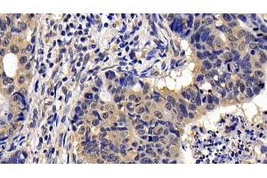 Detection of BLK in Human Lymphoma Tissue using Polyclonal Antibody to B-Lymphoid Tyrosine Kinase (BLK)